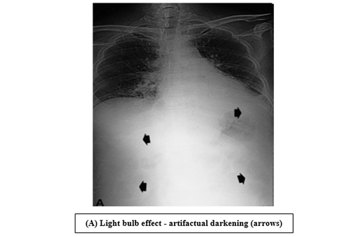 (A) Light bulb effect - artifactual darkening (arrows)