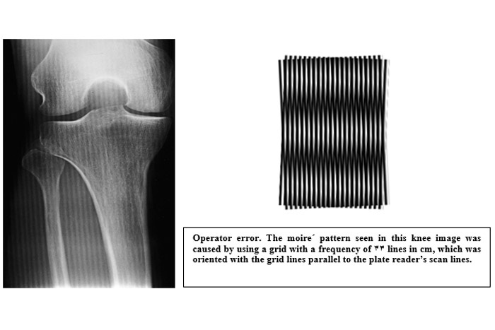 Operator error. The moire´ pattern seen in this knee image was caused by using a grid with a frequency of 33 lines  in cm, which was oriented with the grid lines parallel to the plate reader’s scan lines.