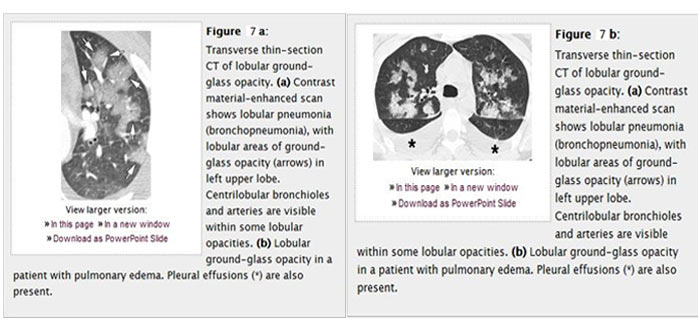CT Paterns of Abnormality and Anatomic Distribution 5