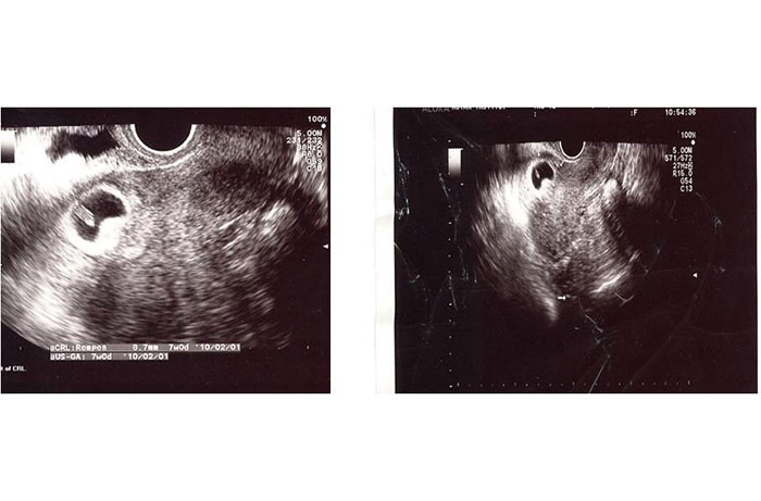 "نمای ساژیتال" در سونوگرافی ترانس واژینال جایگزینی ساک حاملگی با جنین و کیسه زرده را در محل اسکار سزارین در نزدیک مثانه نشان می دهد. - گروه تشخیصی درمانی فرجاد