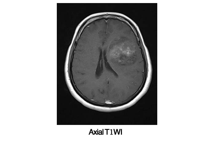 Epilepsy Axial T1WI