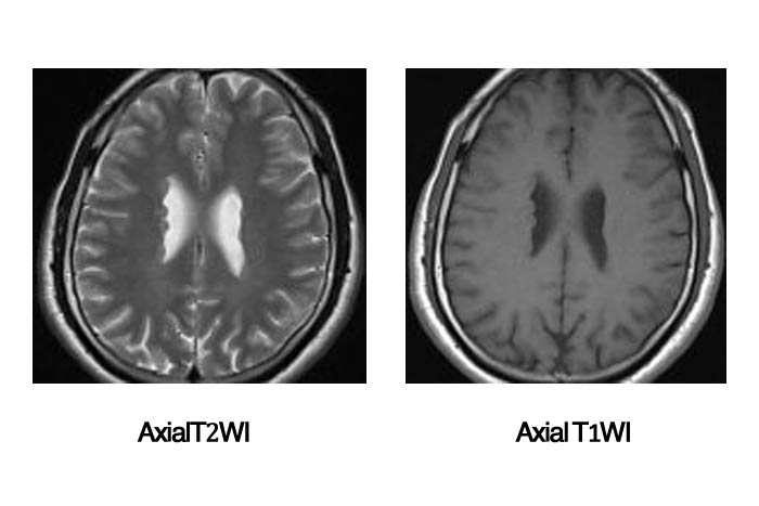 Epilepsy  Axial T2WI Axial T1WI