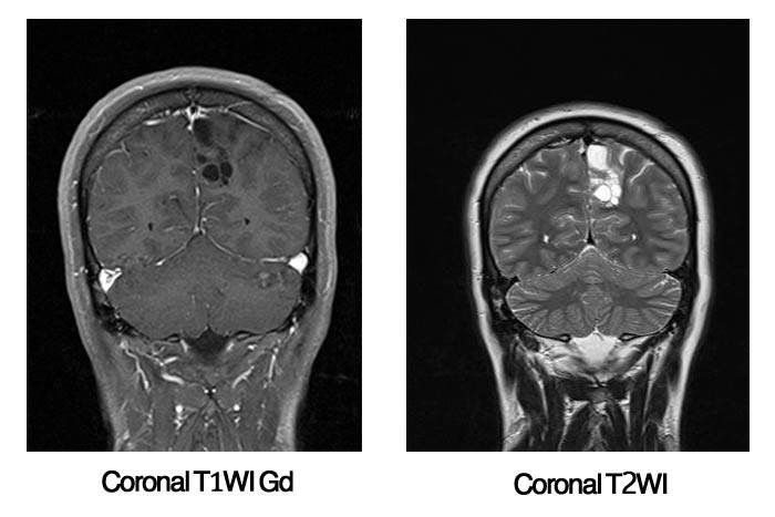 Epilepsy Coronal T1WI Gd Coronal T2WI
