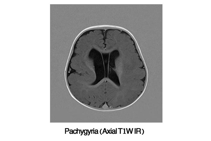 Epilepsy Pachygyria (Axial T1W IR)