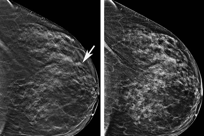 بررسی پستان ها در ماموگرافی