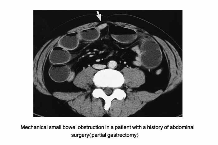 Mechanical small bowel obstruction in a patient with a history of abdominal surgery (partial gastrectomy).