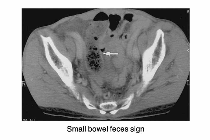 Small bowel feces sign