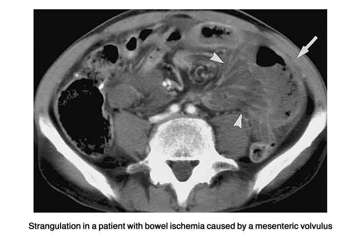 Strangulation in a patient with bowel ischemia caused by a mesenteric volvulus