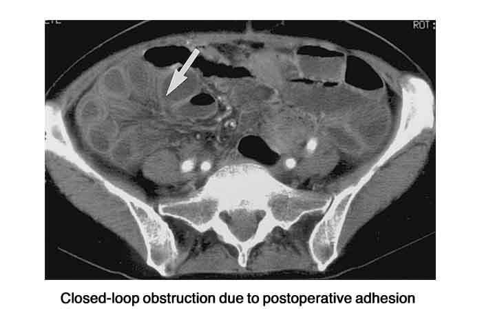 Closed-loop obstruction due to postoperative adhesion