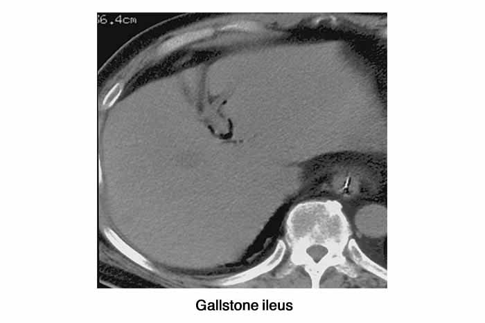 Gallstone ileus