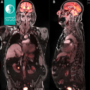 پت ام آر آی چیست؟ هر آنچه باید درباره این فناوری پیشرفته بدانید (PET/MRI)