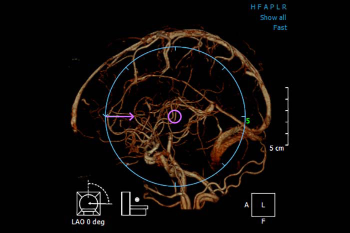 مقايسه ي سي تي ونوگرافي CTV و MRV در بررسي ترومبوز سينوس هاي وريدي مغز - گروه تشخیصی درمانی فرجاد - فرجاد قم - Normal CTV - تصویر اول