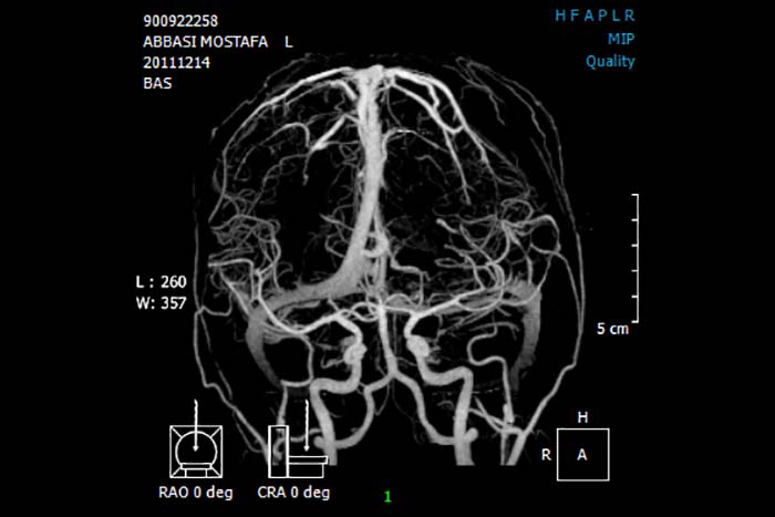 مقايسه ي سي تي ونوگرافي CTV و MRV در بررسي ترومبوز سينوس هاي وريدي مغز - گروه تشخیصی درمانی فرجاد - فرجاد قم - Normal CTV - تصویر دوم