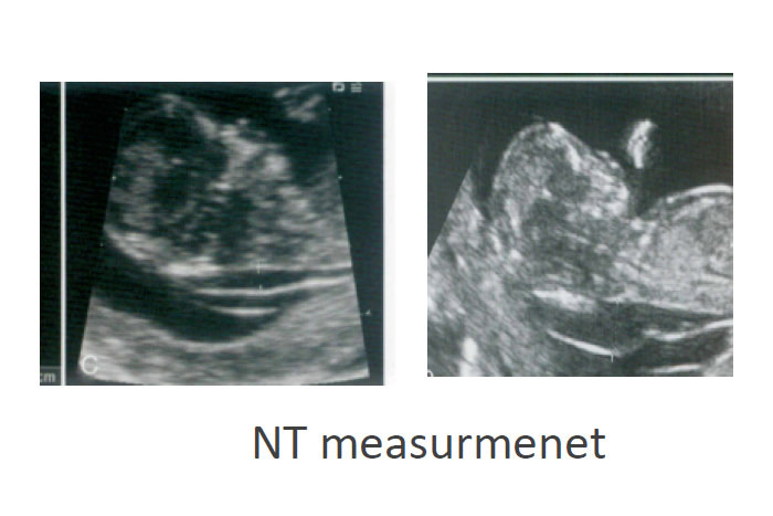 ضخامت NT - گروه تشخیصی درمانی فرجاد - یافته های شایع سونوگرافیکی تریزومی 21 - فرجاد قم