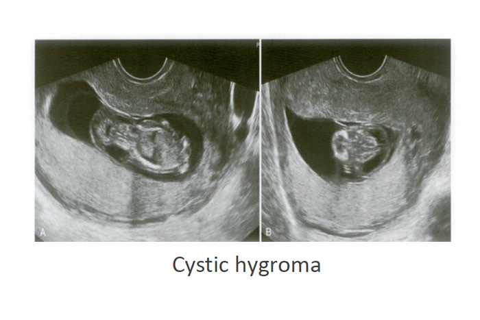 سیستیک هیگروما - گروه تشخیصی درمانی فرجاد - یافته های شایع سونوگرافیکی تریزومی 21 - فرجاد قم