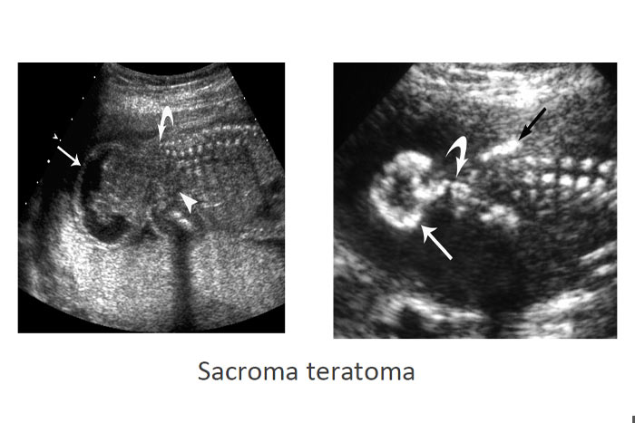 تراتومای ساکروم - گروه تشخیصی درمانی فرجاد - یافته های شایع سونوگرافیکی تریزومی 21 - فرجاد قم