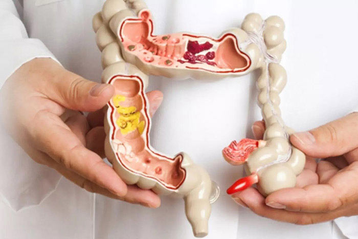 سندروم روده تحریک پذیر IBS
