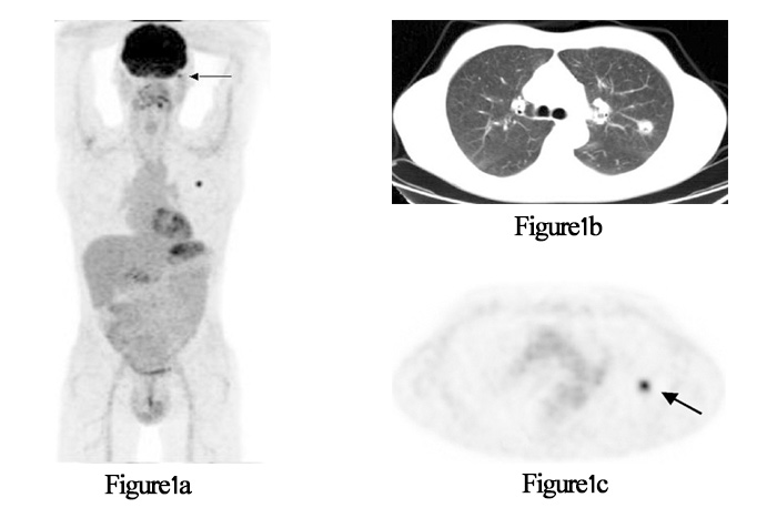 Figure 1(a) , Figure 1(b), Figure 1(c) PET/CT در انکولوژی