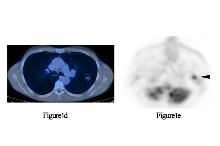 Figure 1(d) , Figure 1(e), PET/CT در انکولوژی
