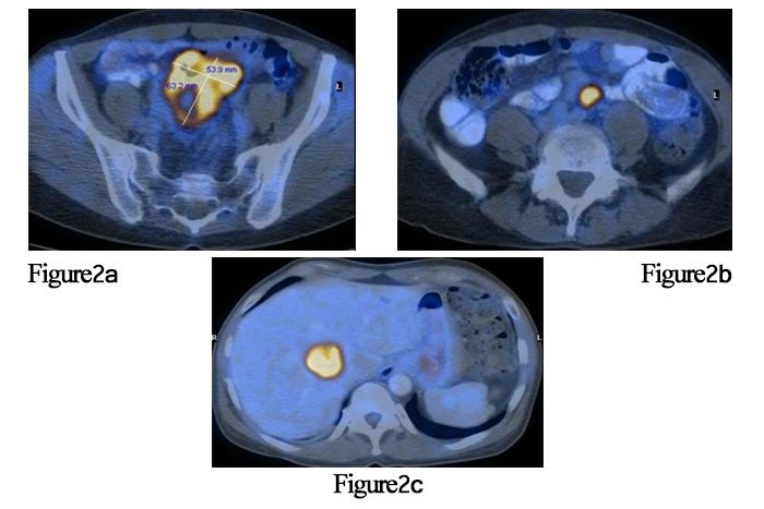 Figure 2(a) , Figure 2(b), Figure 2(c) ،PET/CT در انکولوژی