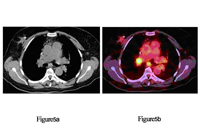  در بیمار مشکوک به بیماری متاستاتیک در کانسر پستان. (a) CT آگزیال، (b) PET/CT فیوز شده آگزیال