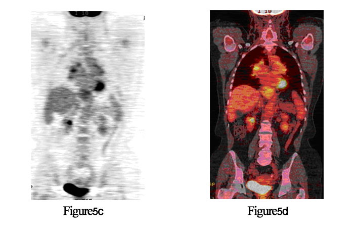بیمار مشکوک به بیماری متاستاتیک در کانسر پستان، (c) PET  کرونال، (d) PET/CT فیوز شده کرونال