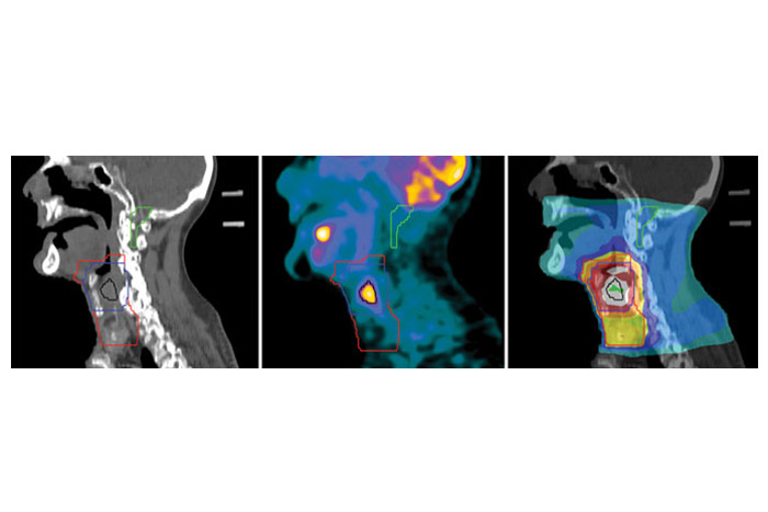 طراحی درمان رادیوتراپی در بیمار مبتلا به اسکواموس سل کارسینومای حنجره